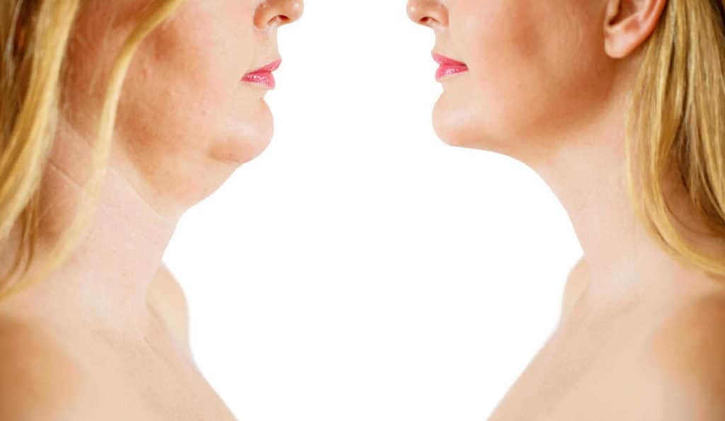 Double Chin treatment Glossop before and after results
