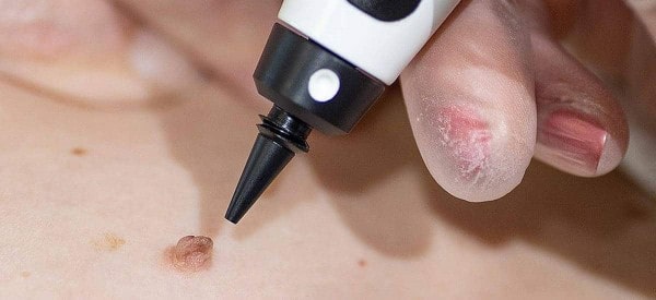 After Skin Tag Removal Glossop