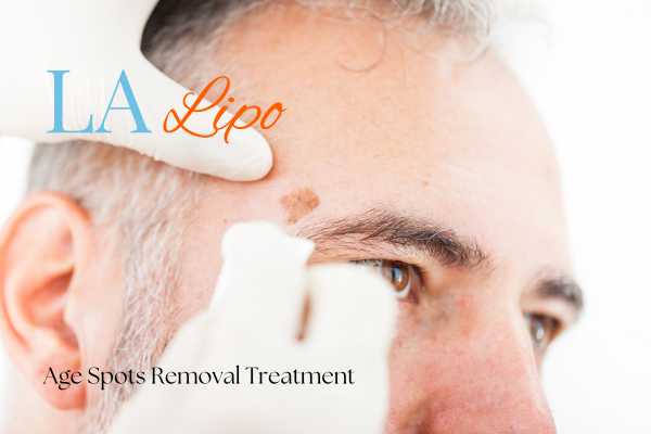 What Are the Most Effective Treatments for Age Spots Glossop?