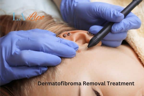 Dermatofibroma Removal Treatment Glossop