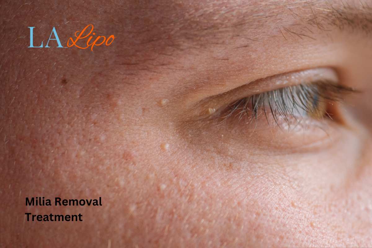 Cryopen Milia Removal: Is It the Easiest and Safest Option Glossop?