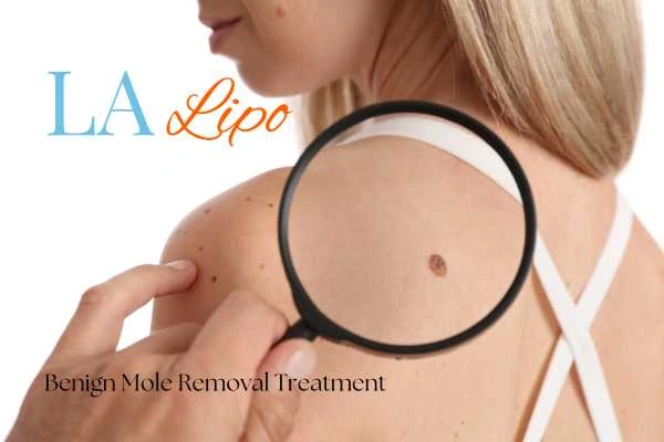 Why getting moles removed Glossop can boost your confidence!