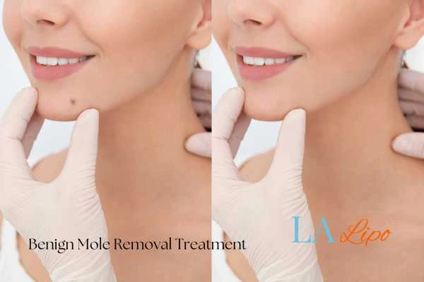 woman's before and after mole removal Glossop results