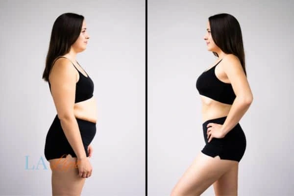 image of woman before and after results of LA-EMS Body Sculpting Glossop to help treat Diastasis recti