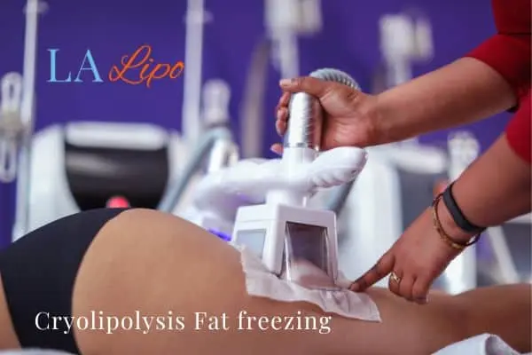women getting fat freezing Glossop