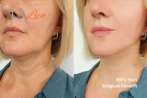 hi-fu for wrinkles Glossop before and after results