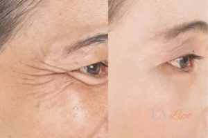 Before and after results of woman - HI-fu wrinkles reduction treatment Glossop