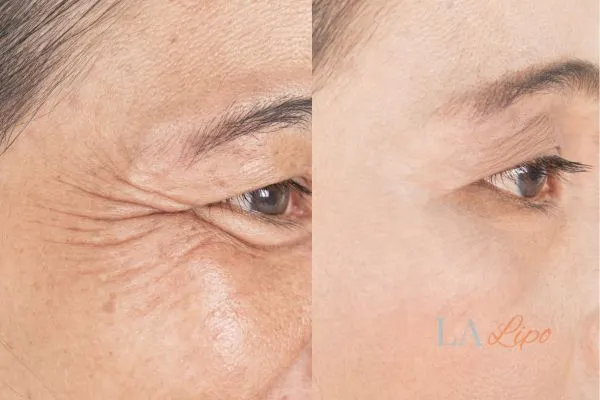Before and after results of woman - HI-fu wrinkles reduction treatment Glossop