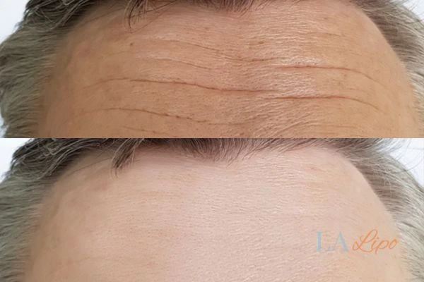 results of HIFU Glossop on mans forehead to help reduce lines and wrinkles