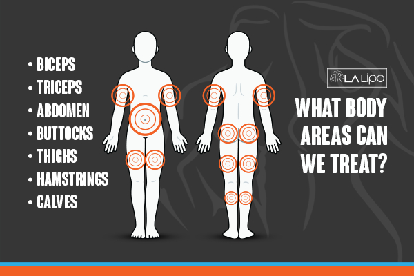 Graphic to show areas you can have LA-EMS Body Sculpting Glossop treatment.