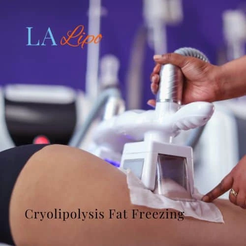 fat freezing - Cryolipolysis Glossop