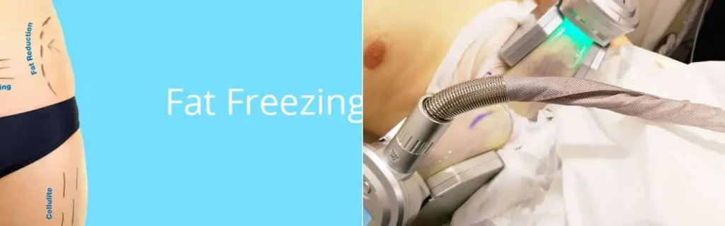 Fat freezing Glossop on multiple areas of the body