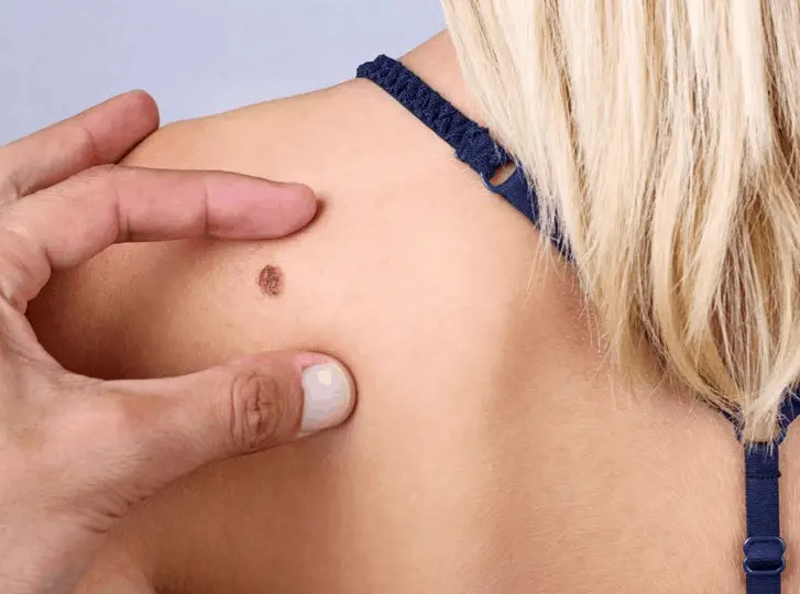 woman having mole removal Glossop consultation before treatment.