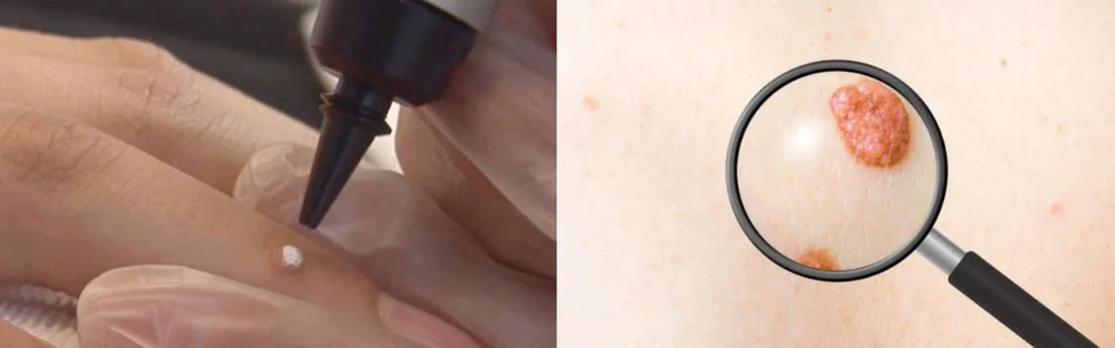 Person getting moles removed with cryopen Glossop