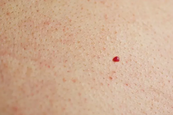 close up of a cherry angioma Glossop