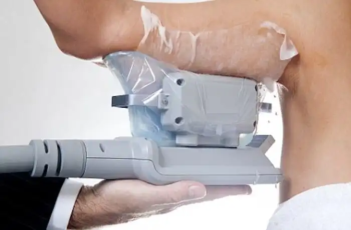 Picture of fat freezing Glossop on the upper arms.