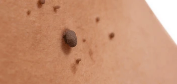 image of a skin tag Glossop