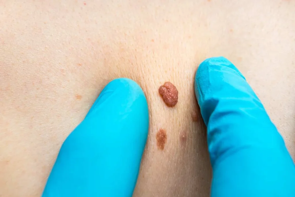 Consultant examining a skin tag Glossop