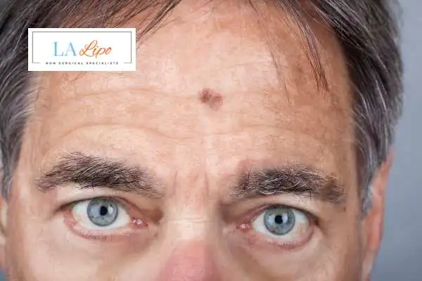 Solar Lentigo Removal Glossop image of man with mark on his forehead