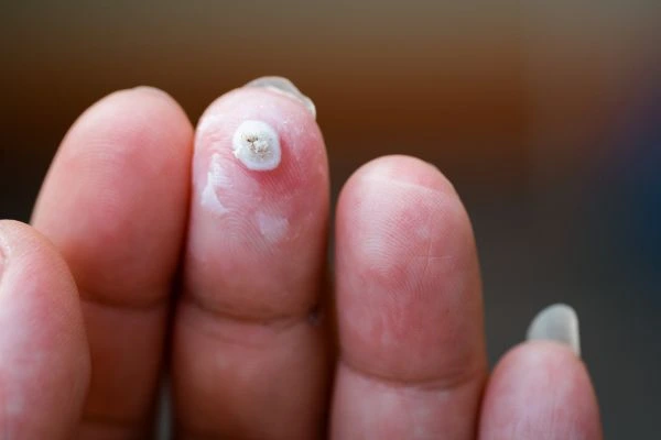 wart on person finger - cryotherapy to treat from LA LIPO Glossop