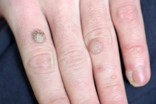 photo of warts on person hand - see wart removal Glossop from LA LIPO