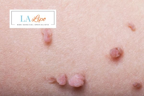 Does cryopen skin tag removal Glossop hurt? Find out now call our team today!