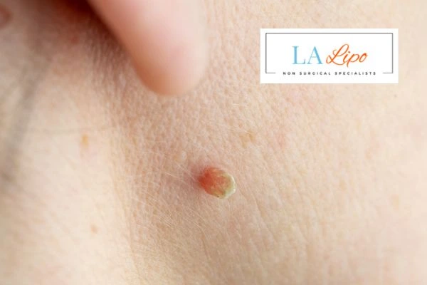 Book skin tag removal Glossop today speak to our team now!