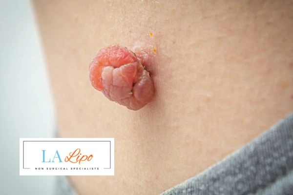 Interested in skin tag removal Glossop? Concerned about the pain? Find out more today!