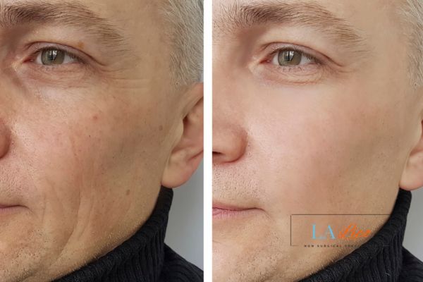 See the amazing results of Morpheus8 Treatment Glossop!