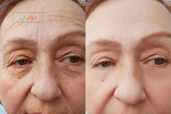 The powerful benefits of Morpheus8 Treatment Glossop - Call Our team today!