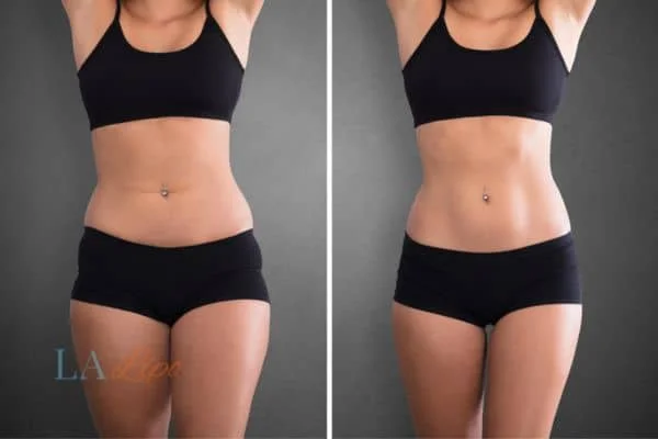 before and after results of non-surgical treatment to help a woman's body image and mental health Glossop