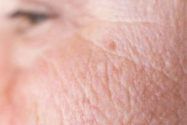 close up picture of a woman's face showing an age spot Glossop