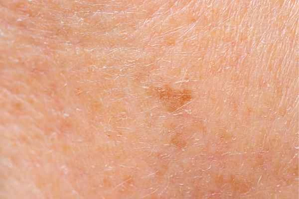 close up picture of age spots Glossop