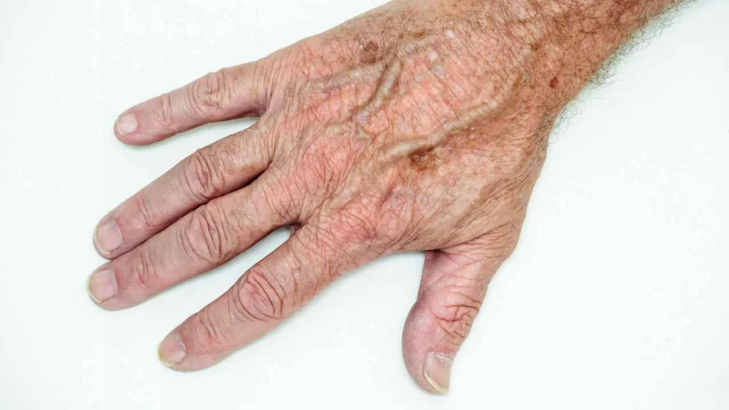 Male hand showing age spot Glossop
