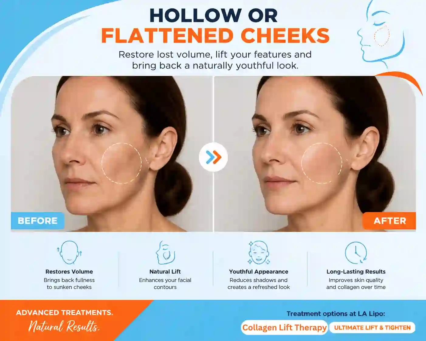 Sign #4: Hollow or Flattened Cheeks Glossop