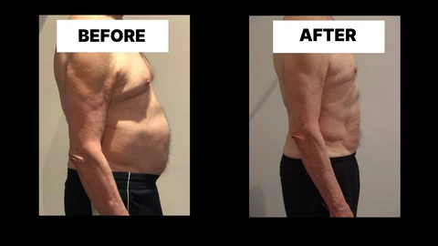 What Symptoms Can Diastasis Recti Cause in Men? Weak Core, Back Pain and Poor Posture Glossop